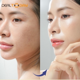 Thẩm mỹ viện Ngọc Dung - Meso căng bóng da